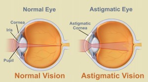astigmatism-tratament